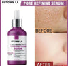 Anti-Acne Face Serum