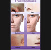 Anti-Acne Face Serum