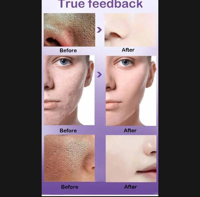 Anti-Acne Face Serum